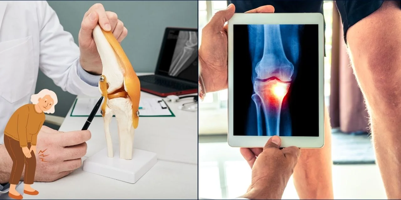 How to Recognize the Early Signs of Osteoarthritis